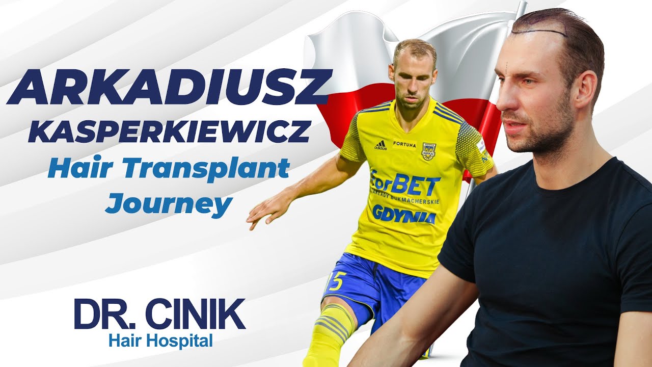 Arkadiusz Kasperkiewicz | Hair Transplant | Dr. Emrah Cinik