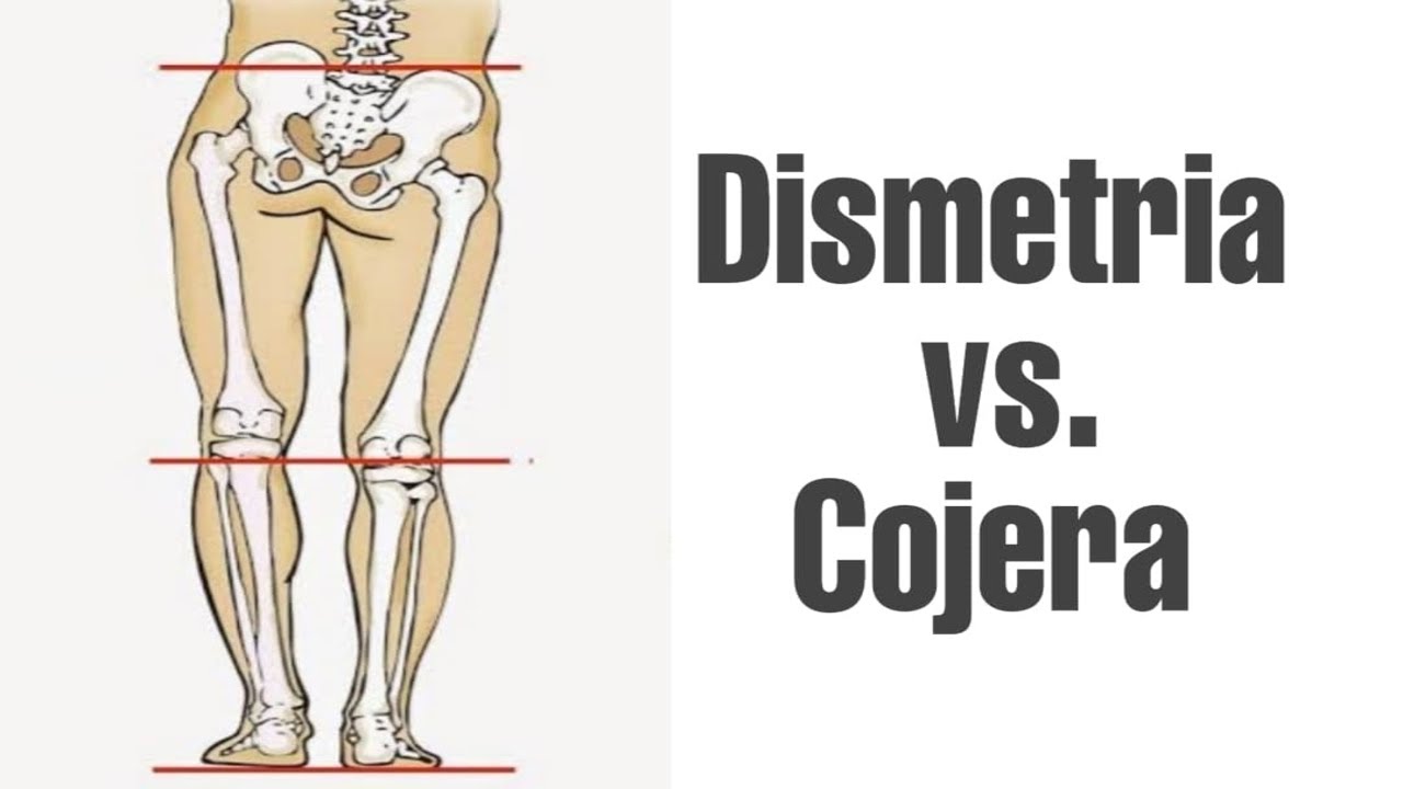 Dismetrìa vs Cojera - Tips y Consejos