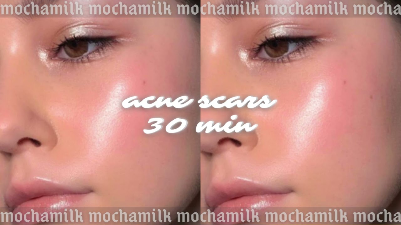 ☁️ ❝get rid of acne scars - 30min ver. - request❞ Subliminal | LISTEN ONCE | ☁️