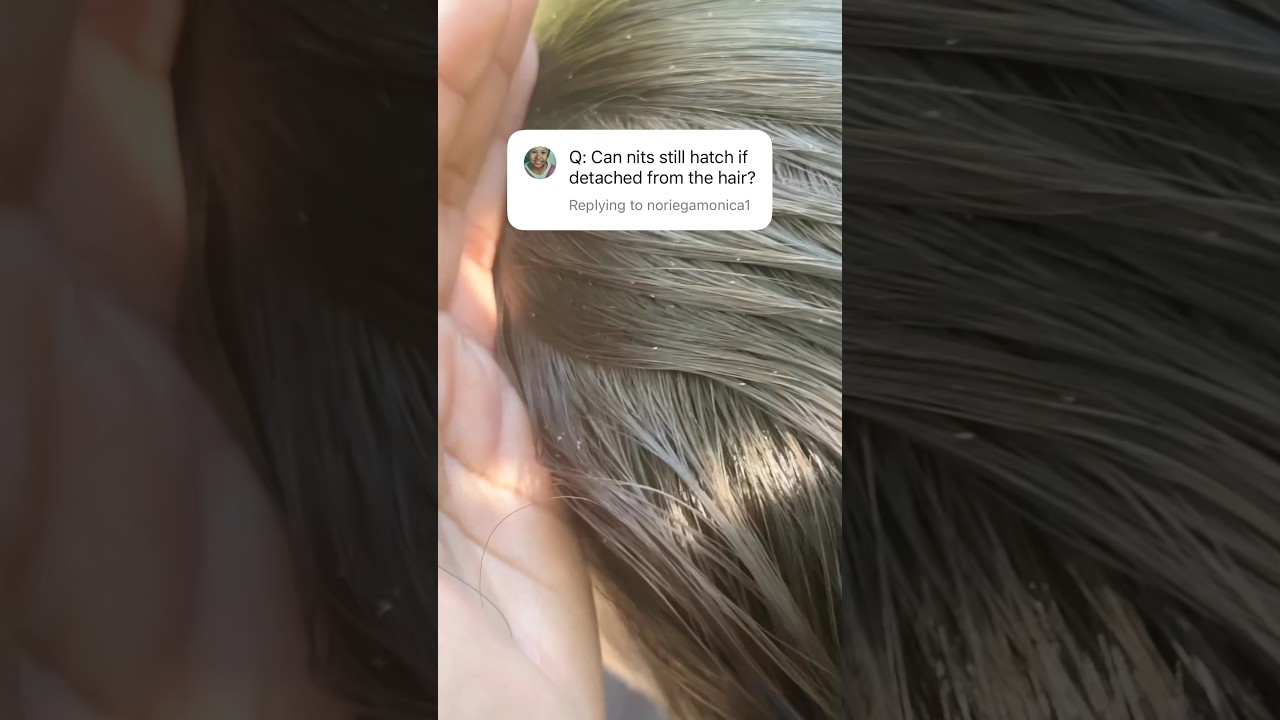 Nits of the hair l lice eggs l lice removal