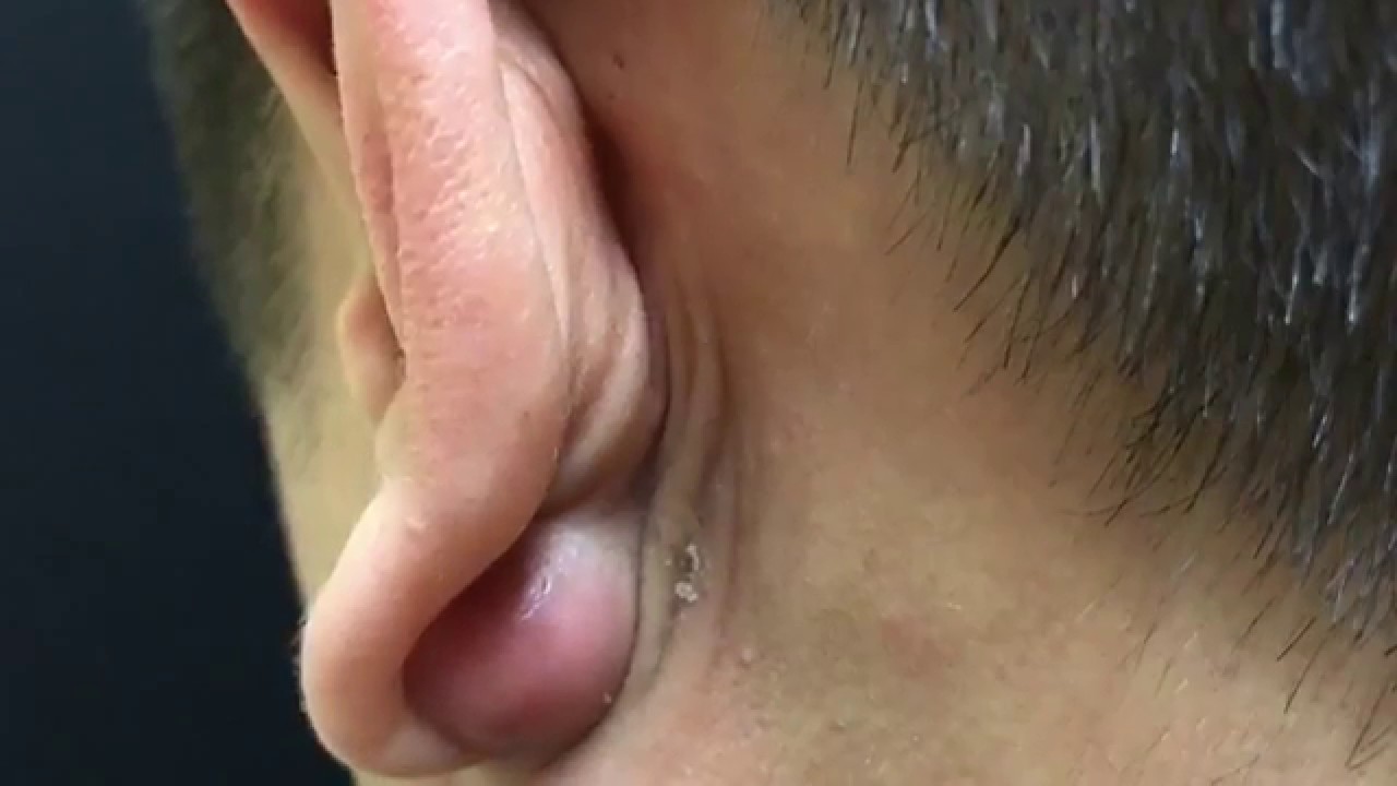 HOW TO REMOVE A MASSIVE CYST