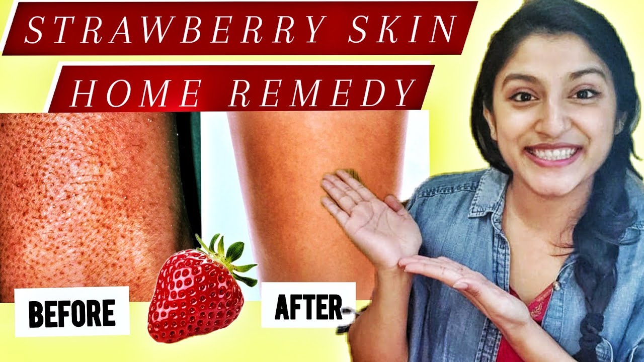 HOW TO treat KERATOSIS PILARIS/STRAWBERRY SKIN/CHICKEN SKIN at home | Ingrown hair on arms & legs🌼