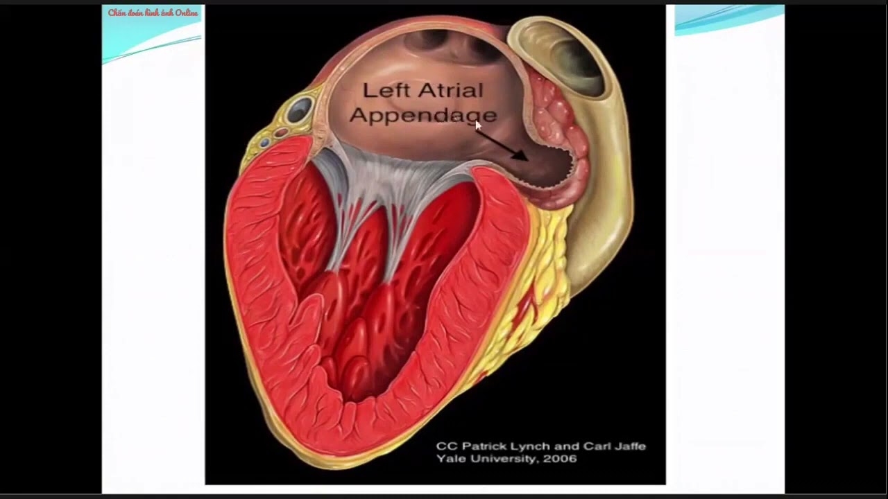 Bài 20: Siêu âm tim - Hẹp van hai lá  | TS.BS Tạ Thị Thanh Hương