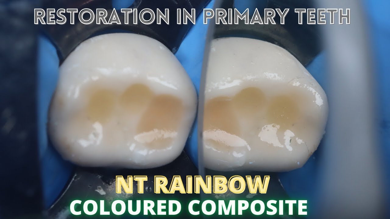 Restoration in Primary Teeth ⚪️ NT Rainbow Coloured Composite 🟢