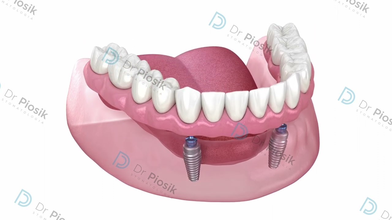 proteza na 2 implantach na zaczepach kulowych