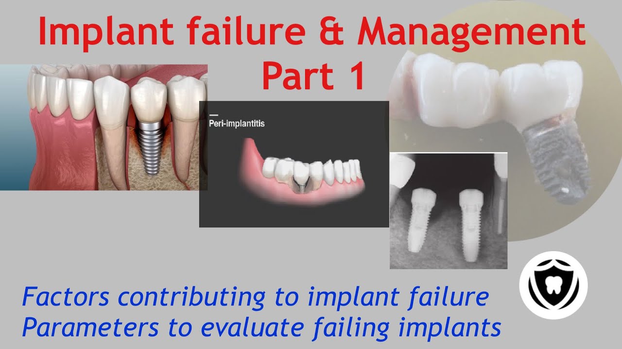 Implant failure & Management : Part 1