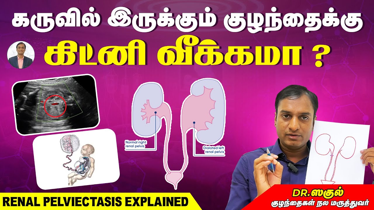 கருவில் இருக்கும் குழந்தைக்கு கிட்னி வீக்கமா ? | Renal Pelviectasis | Dr Sagul's Paediatric corner