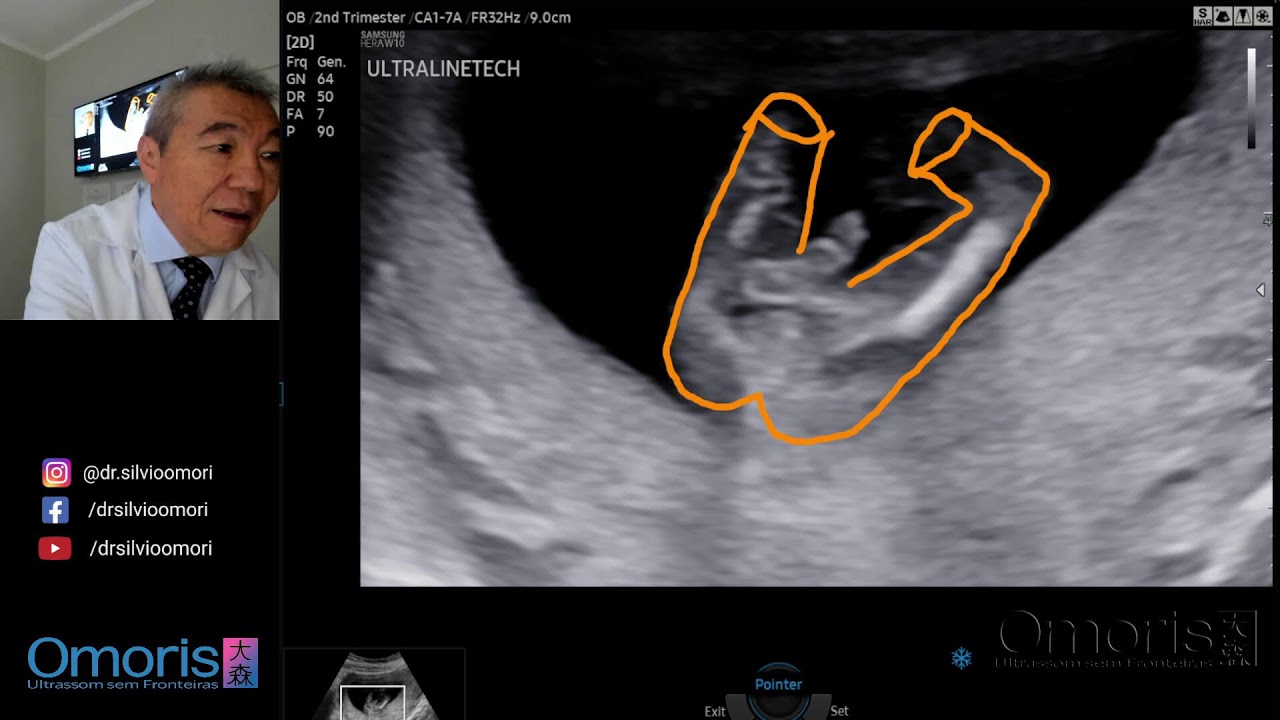 LUTO PÓS ABORTO!