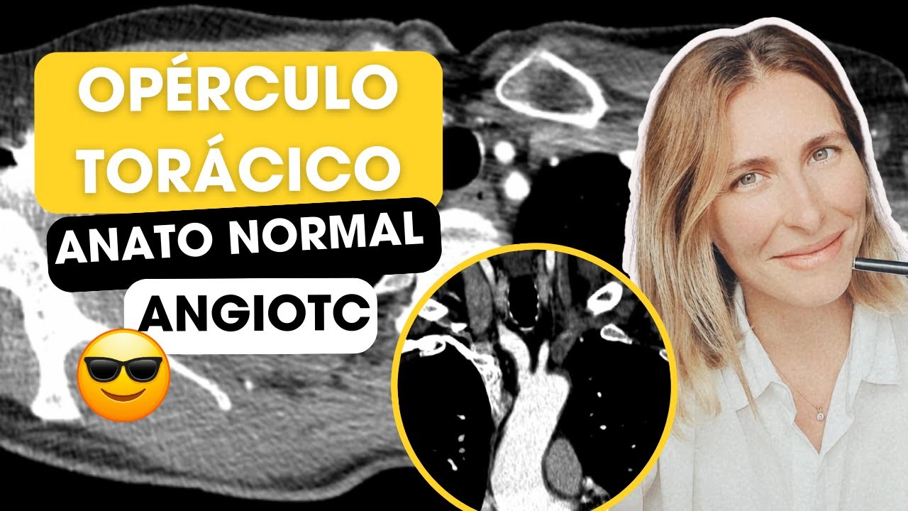 Opérculo toracico! Anatomía normal por angioTC ✅