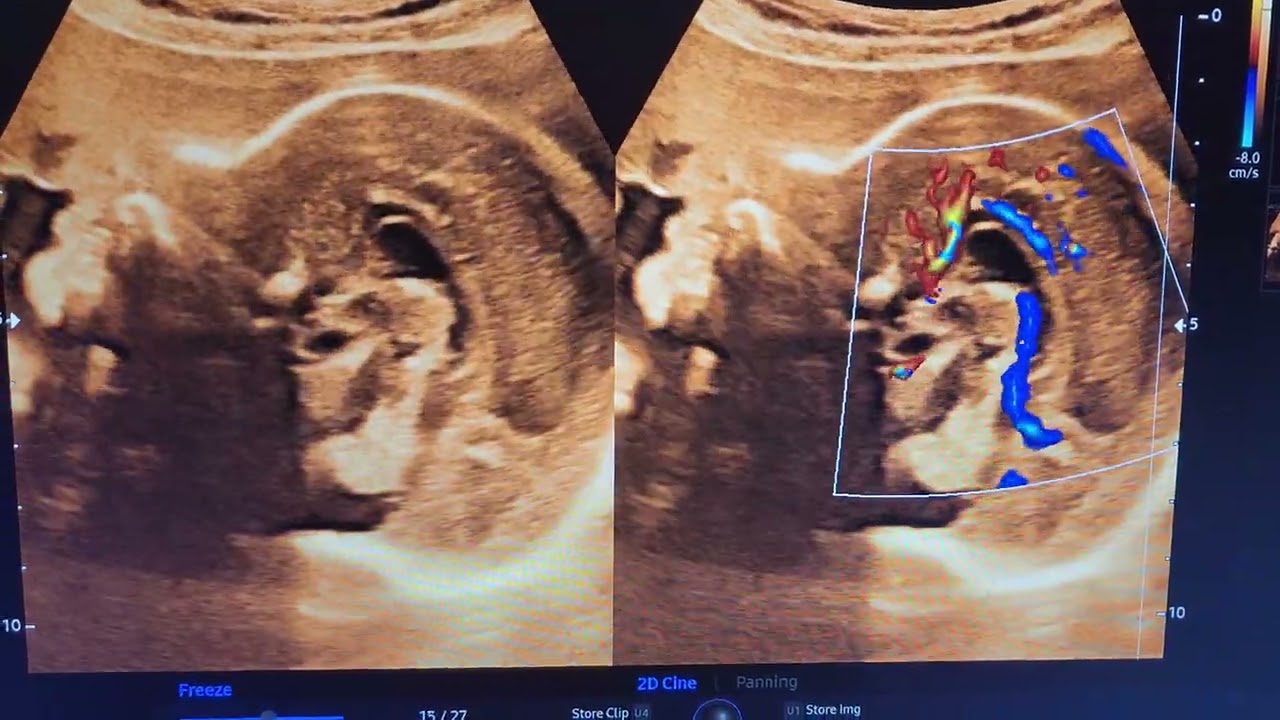 corpus callosum...#fetalneurosonogram, #fetalmedicine