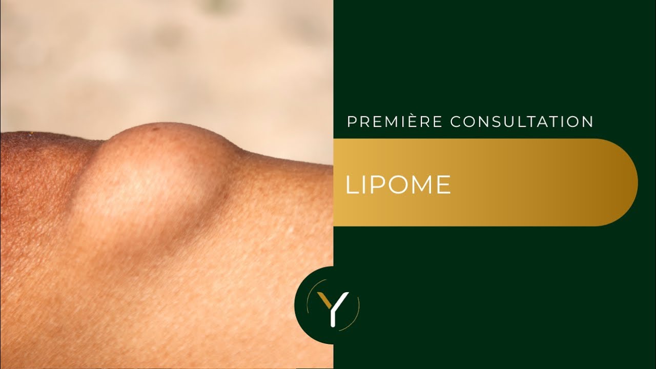 Lipome