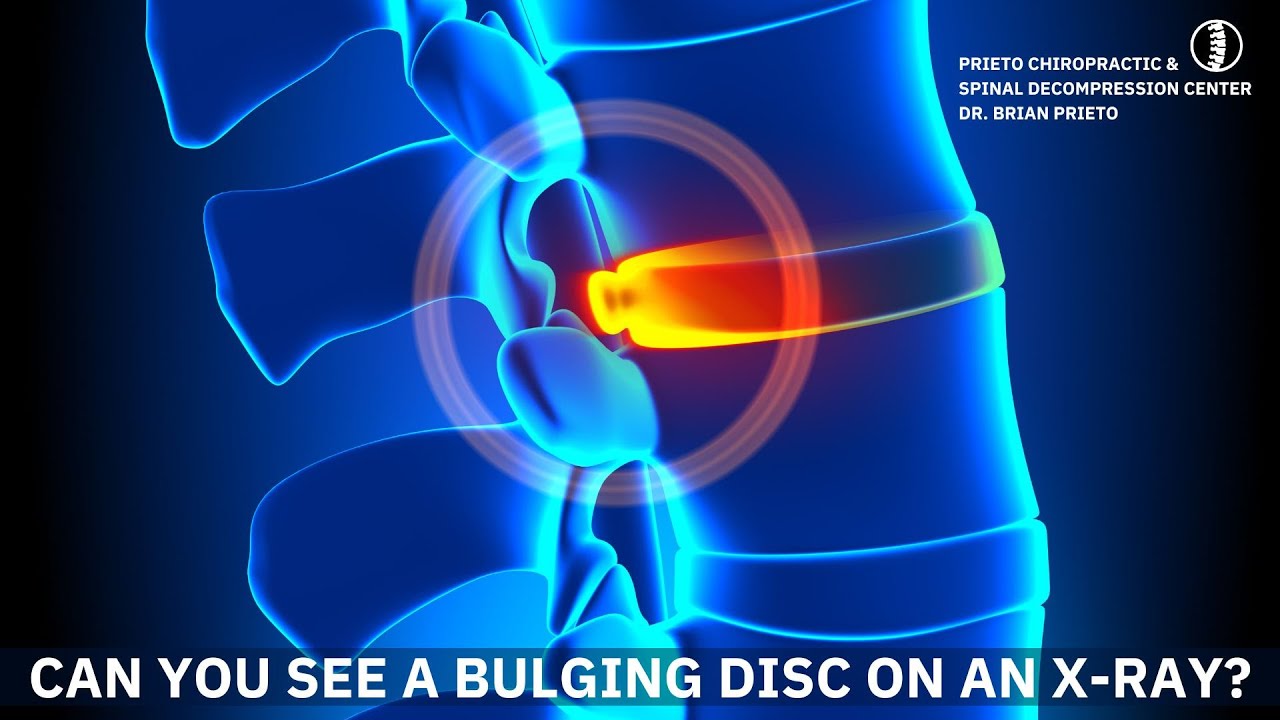 Bulging Disc On An X-Ray Yorba Linda CA