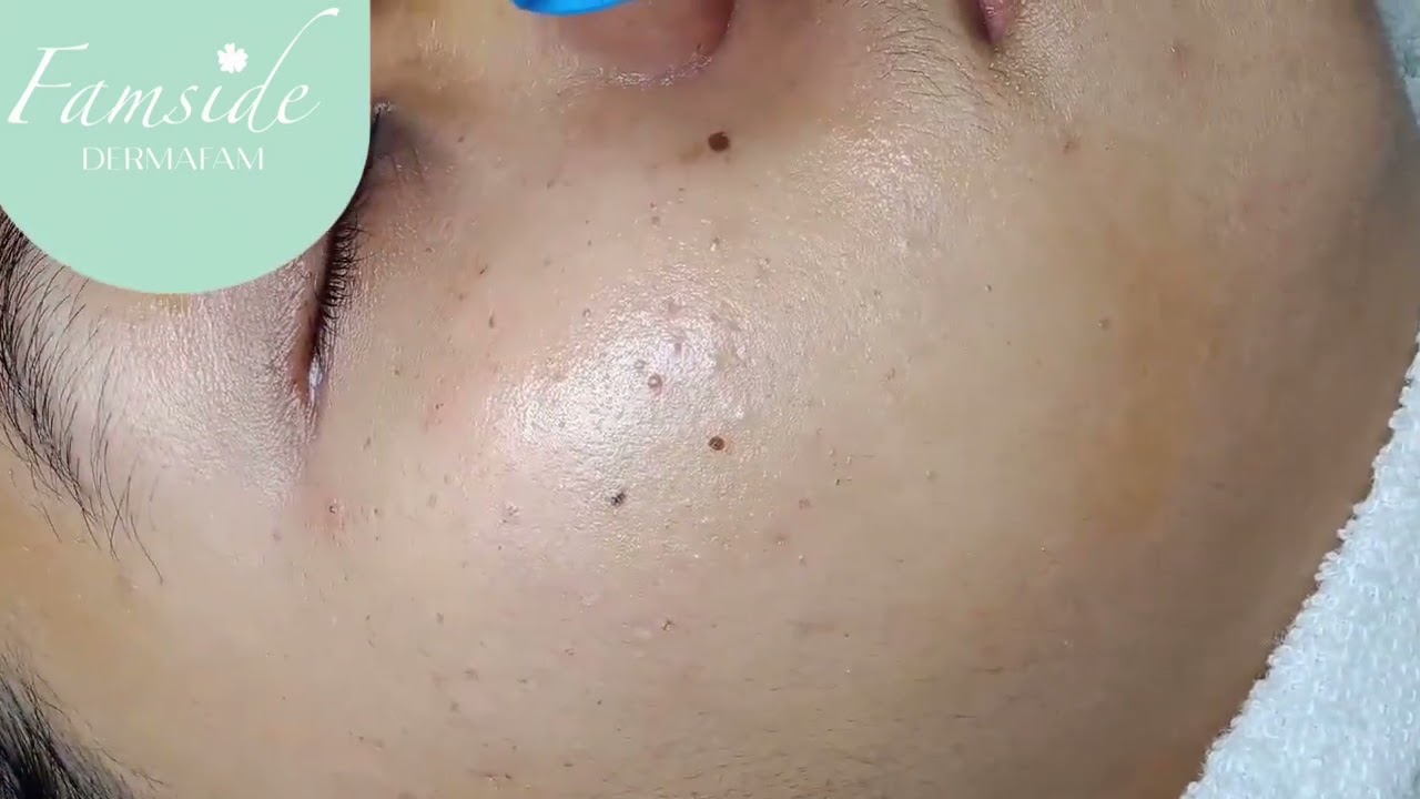 Electrocauter di Famside Dermafam 🤗