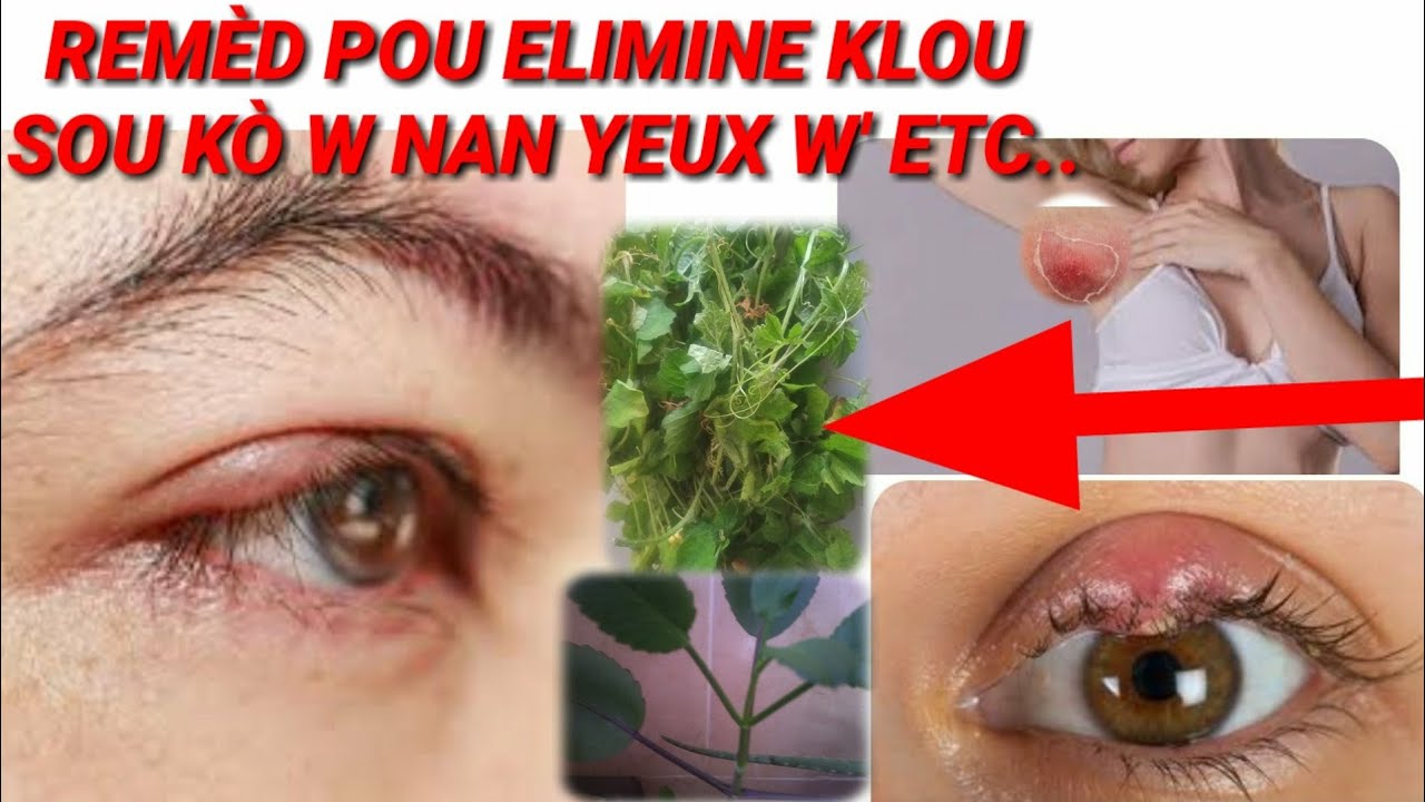 Rem&egrave;d pou Elimine klou nan k&ograve; w' nan yeux  Etc..definitivman av&egrave;k s&egrave;lman de engredyan