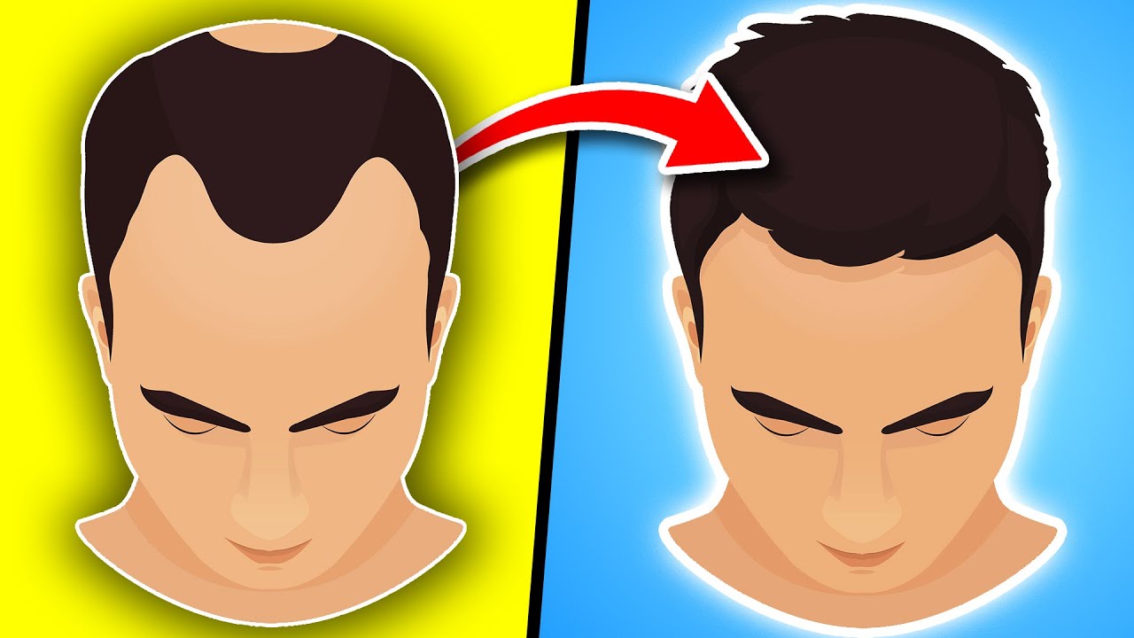 Men: 10 Things You MUST Start To Naturally Regrow Your Hair