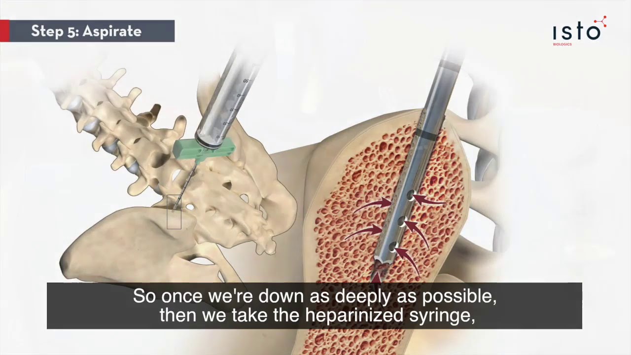 Bone Marrow Aspiration with Dr. Mark Chang, M.D.