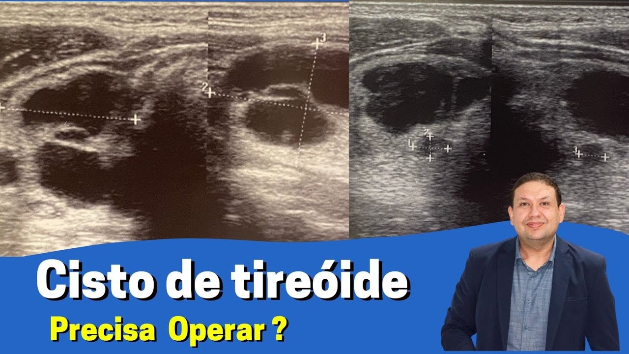 Cisto de tire&oacute;ide &eacute; perigoso?? Descobriu um cisto na tire&oacute;ide no ultrassom, e agora ?