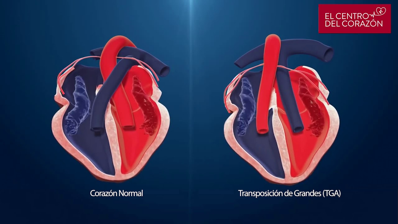 Transposición de las grandes arterias