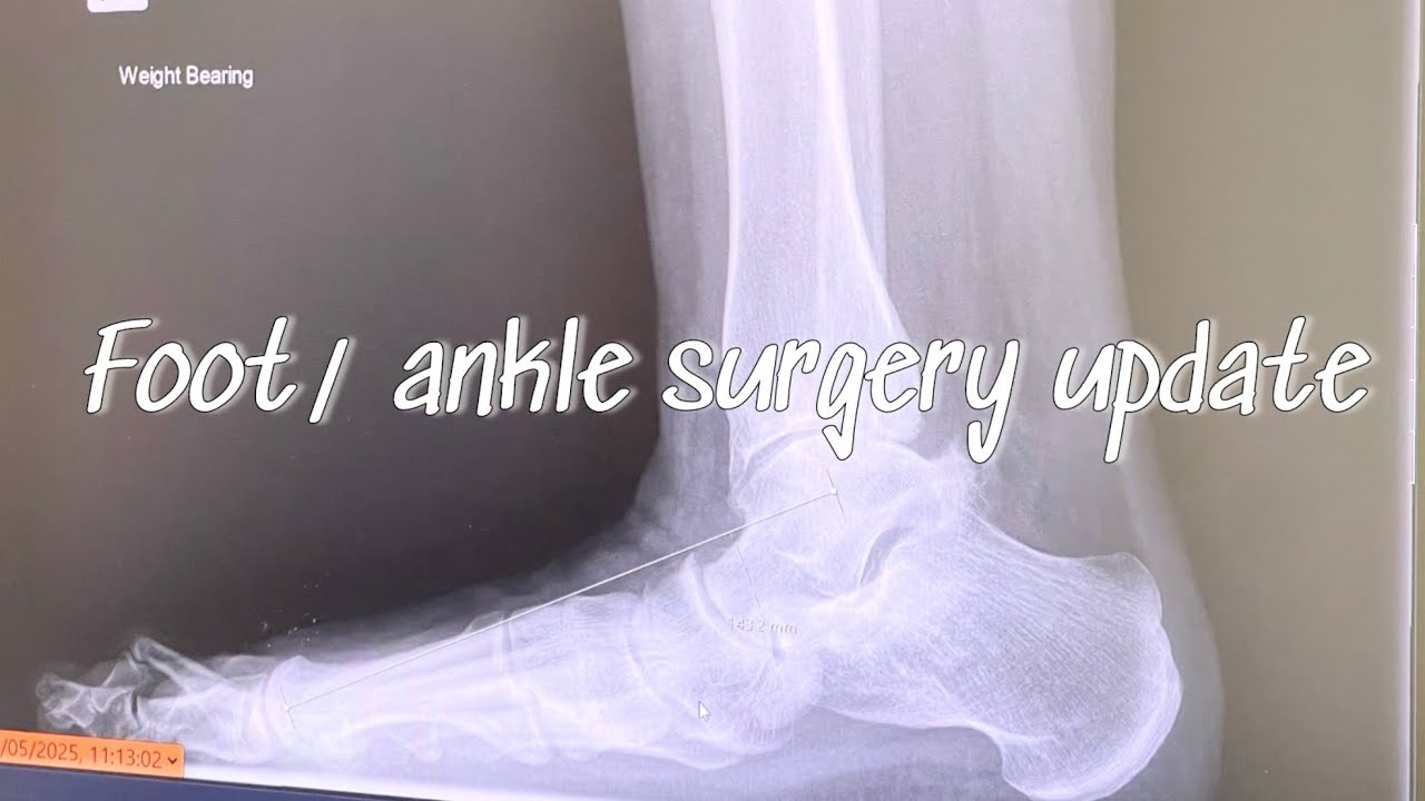 Foot/ ankle surgery update 