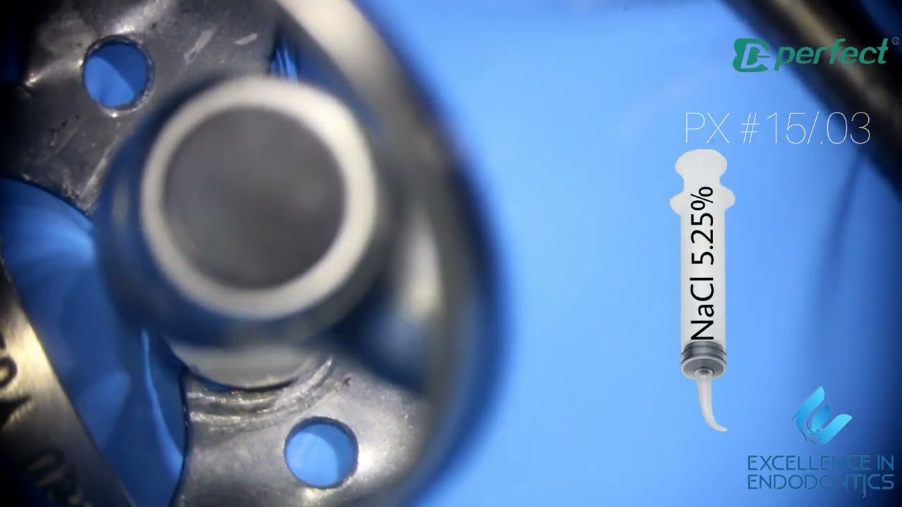 USO DE MG3 BLUE/ PERFECT ENDO EN PREMOLAR SUPERIOR/ Dr. Omar Teniente