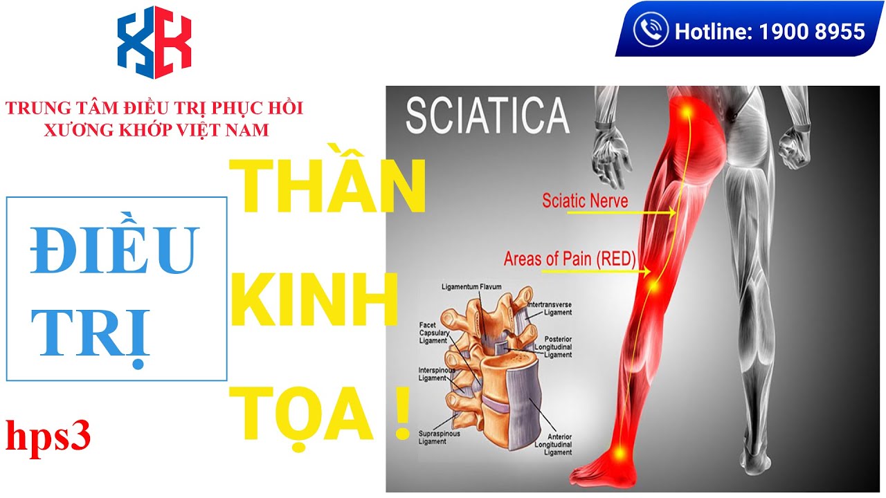 Đau d&acirc;y thần kinh tọa hps3