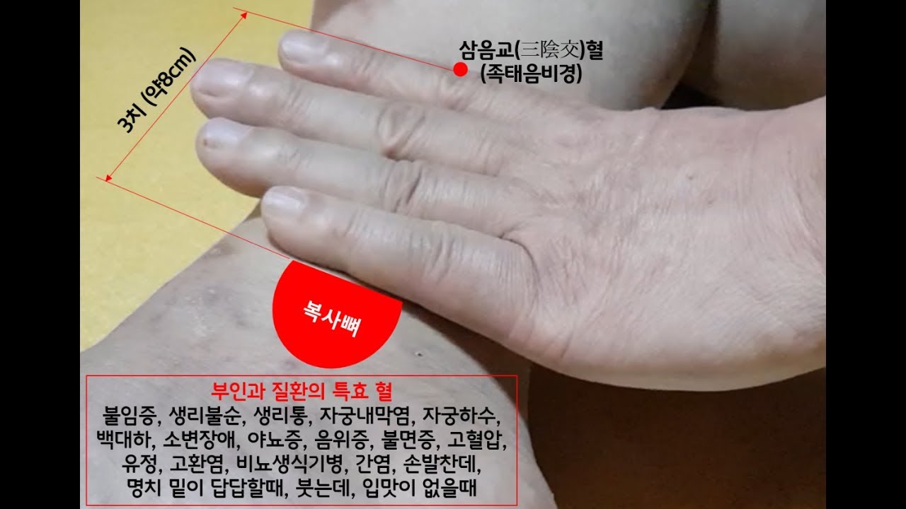 봉침(벌침)-[특효]산부인과 질병의 특효 혈(삼음교 봉침)