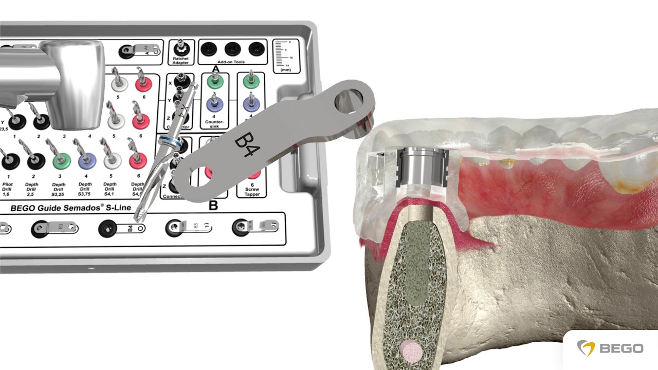 Guided Surgery with BEGO Guide S-Line