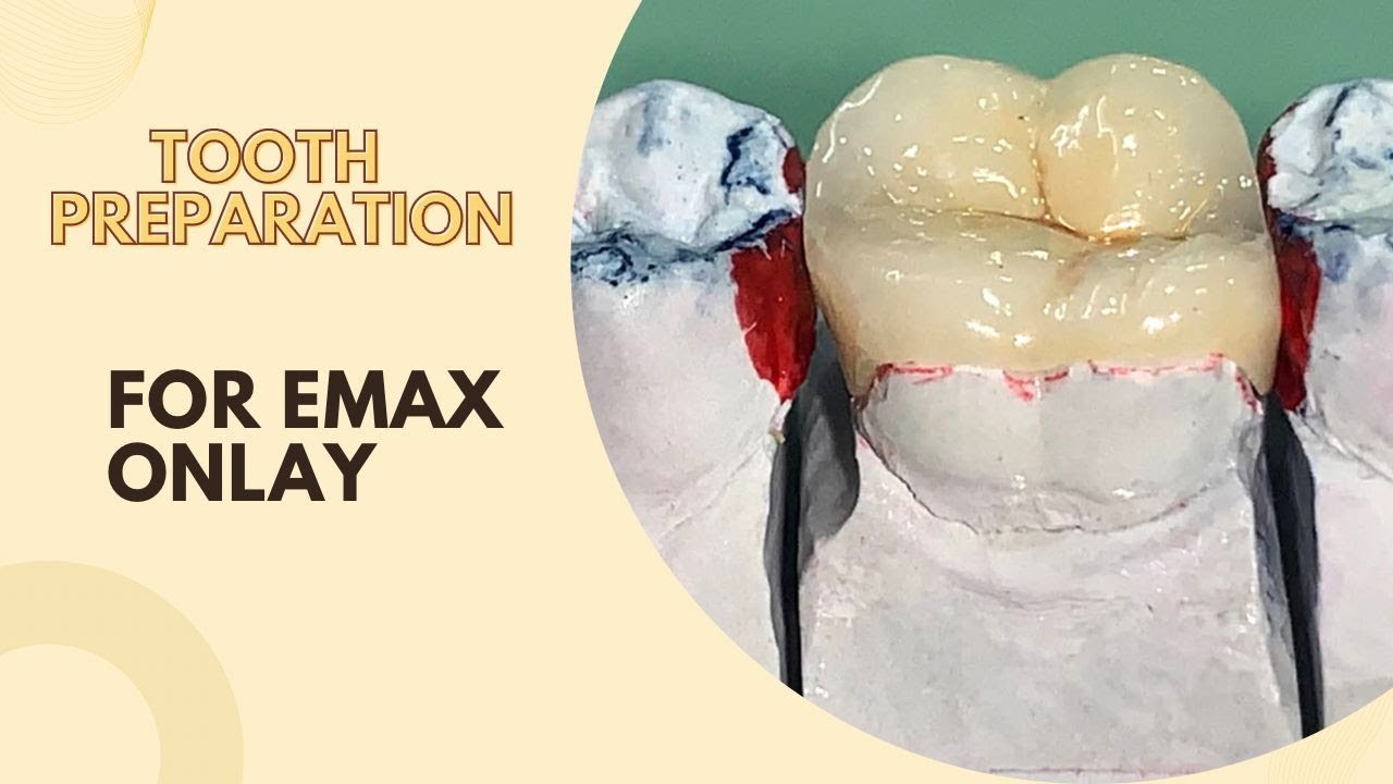 Onlay Tooth Preparation (Indirect Restoration Part 1)