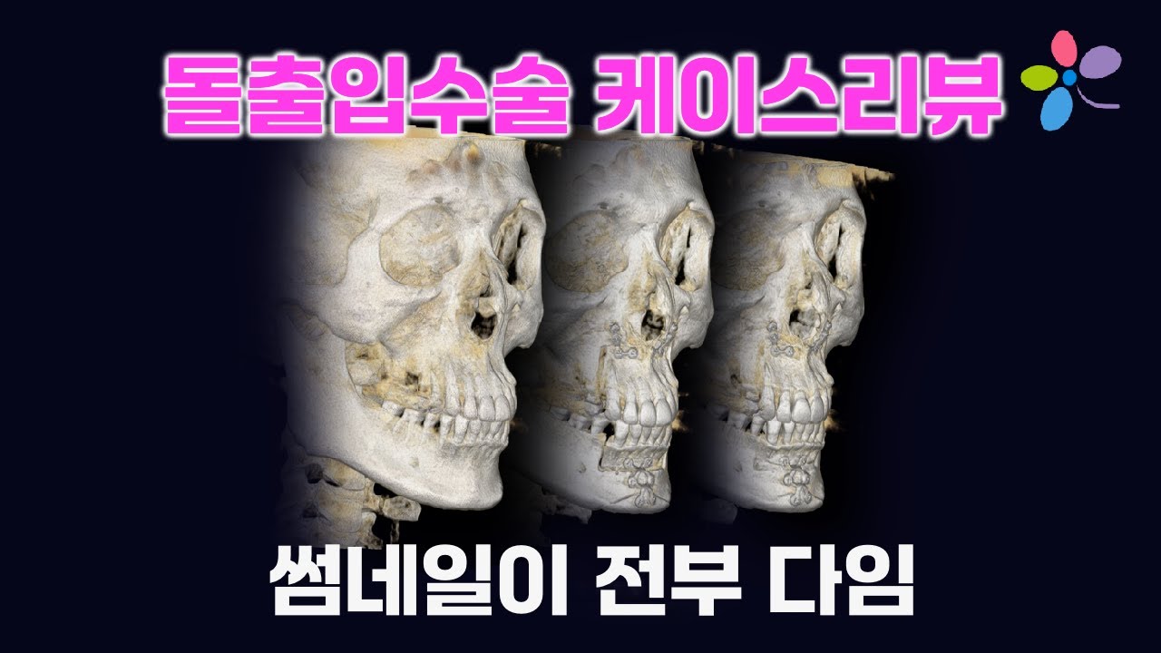 돌출입케이스리뷰   40대의 팔자주름을 호소하는 돌출입환자의 치료
