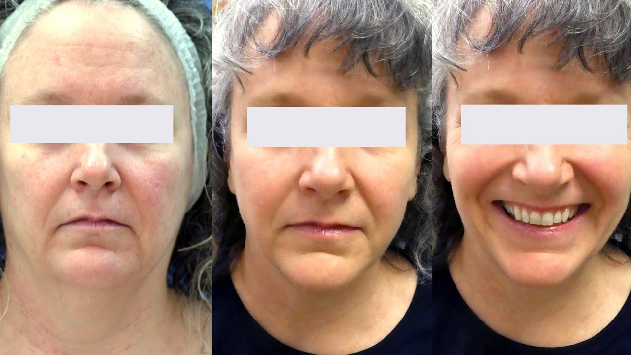 FaceTite Treatment for Neck and Jowl Skin Tightening