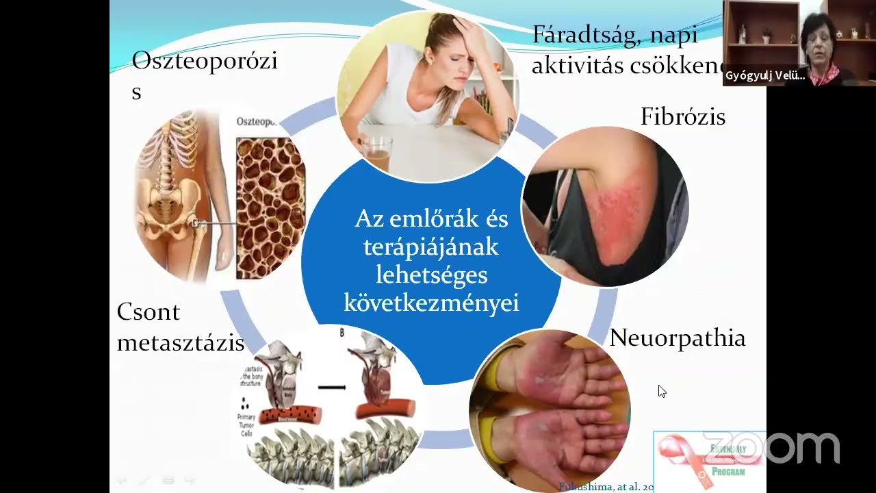 Mellrák: lehet gyorsabban, teljesebben felépülni? - Kapitány Zsuzsanna fizioterapeuta előadása