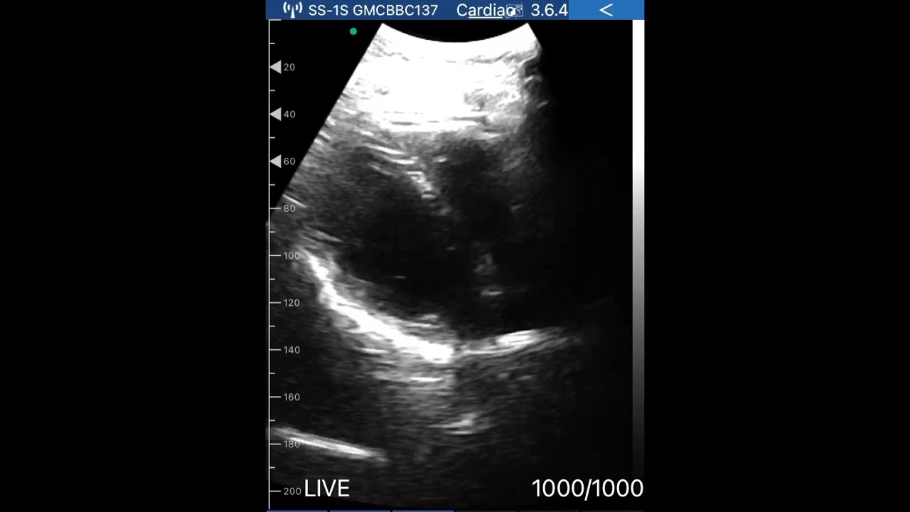 Heartbeat While Smoking With Echo