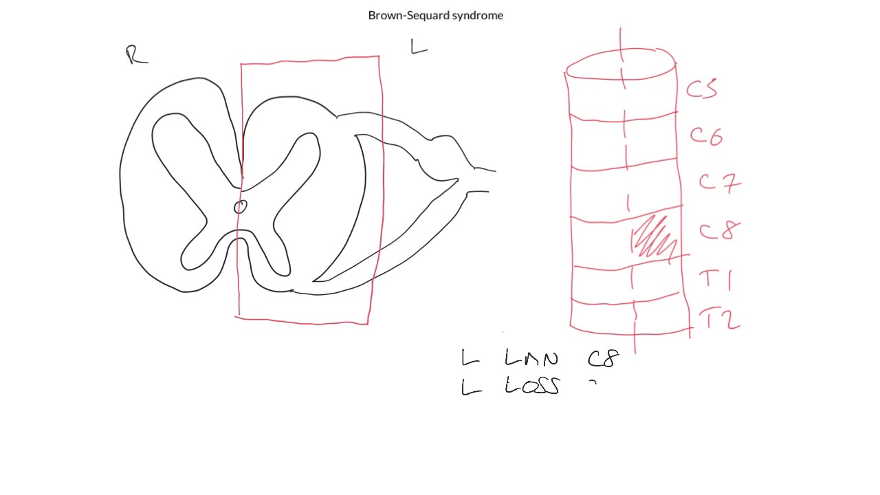 Brown-Sequard syndrome