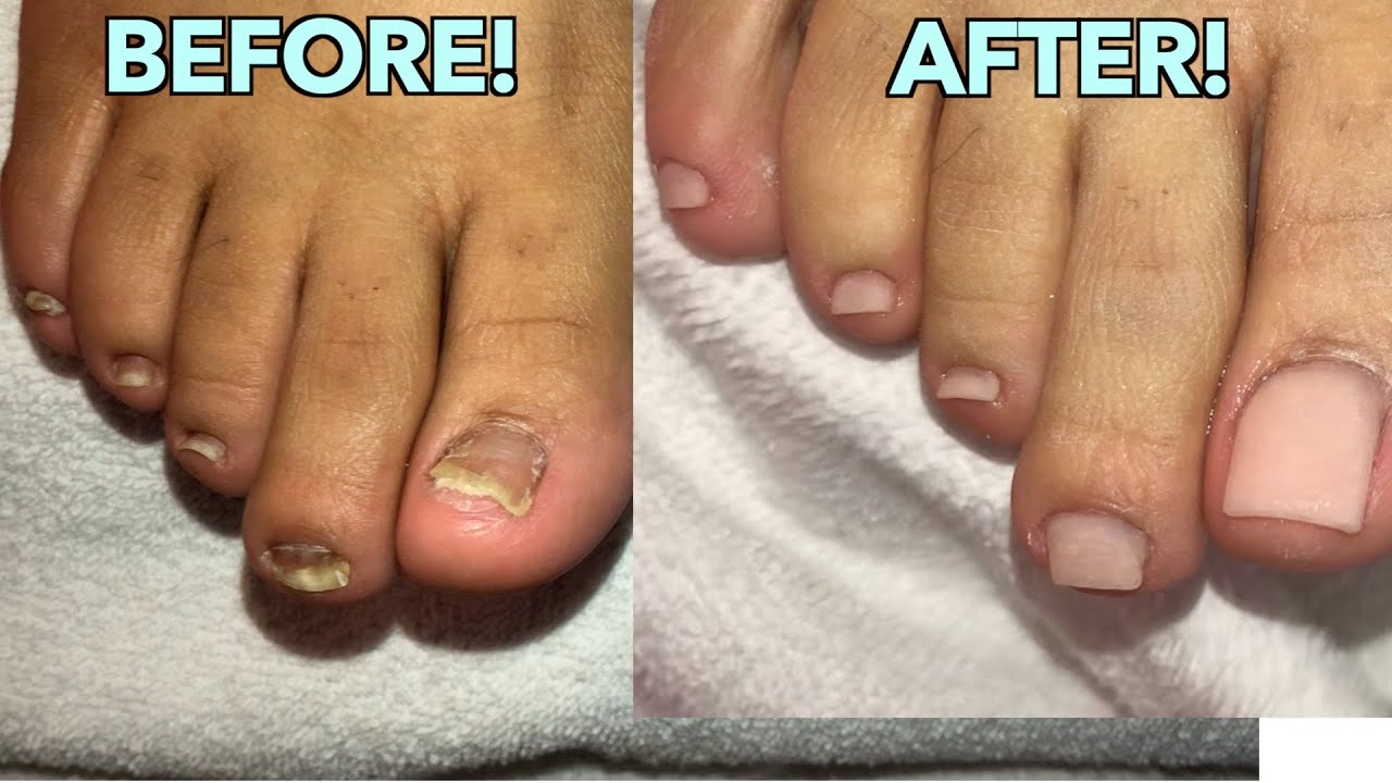 ACRYLIC TOES TUTORIAL| DAMAGED TOENAIL | NO TIPS! NATURAL OVERLAY