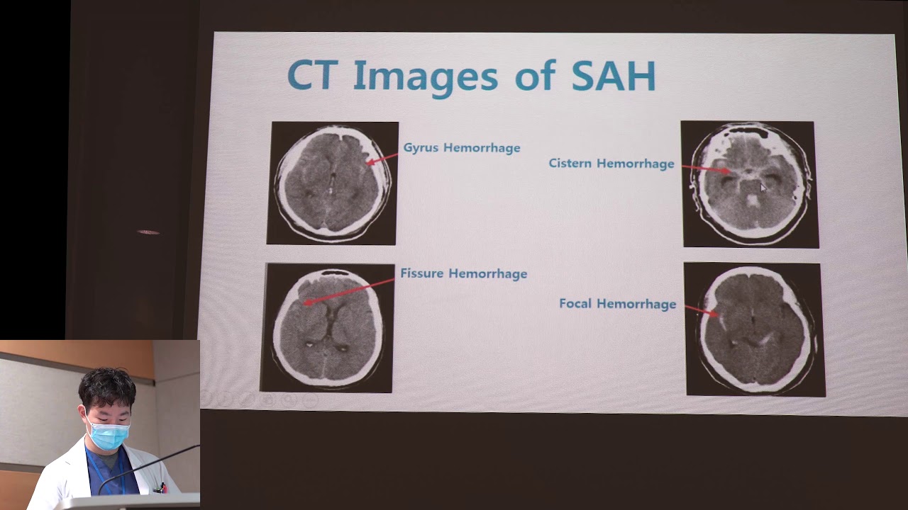 Subarachnoid Hemorrhage (SAH)