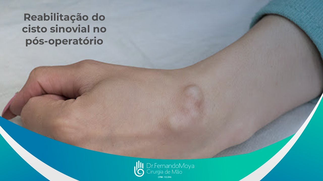 Reabilitação do cisto sinovial no pós-operatório | Dr. Fernando Moya CRM 112046