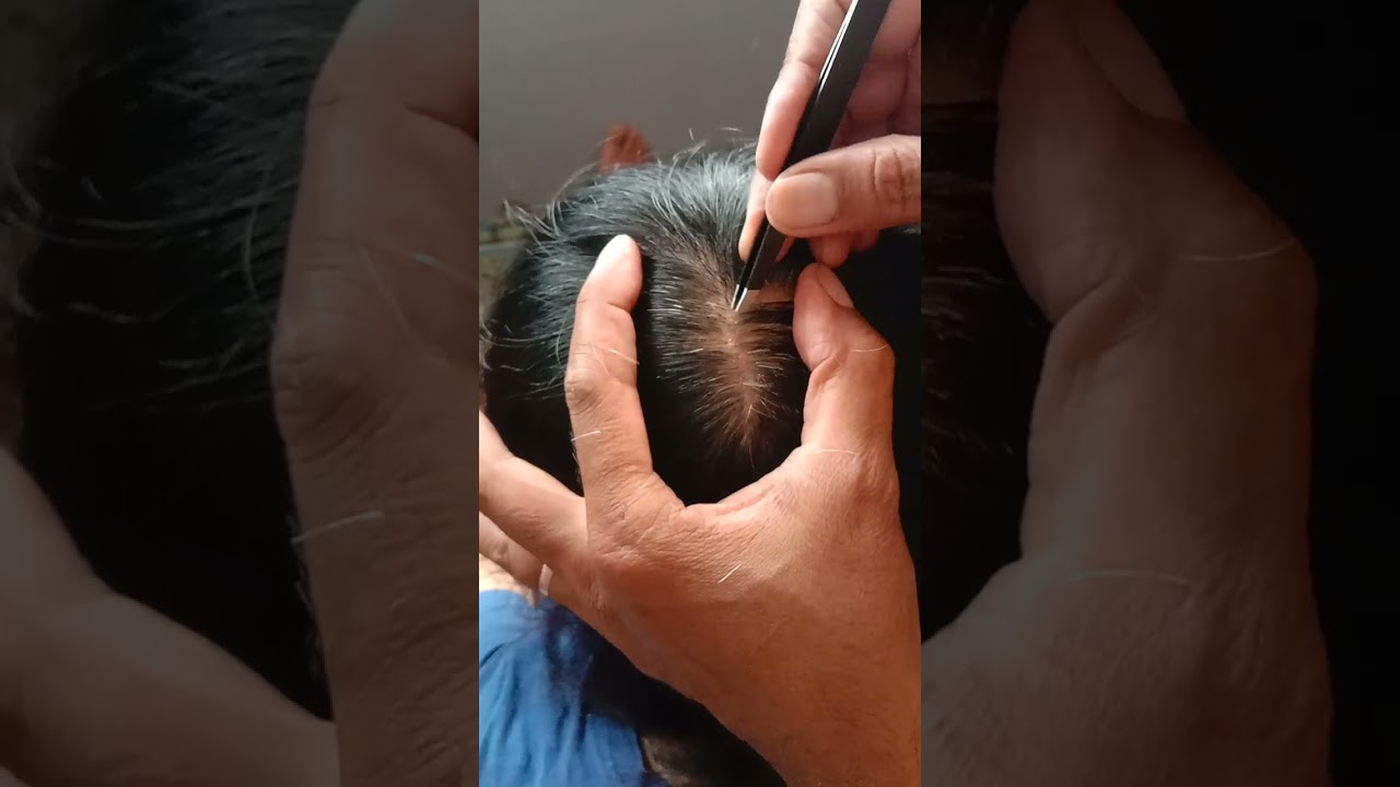 MOST satisfying white hair removal 0.43#relaxing #stressreliver #itchyscalp