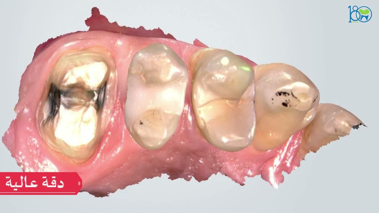 Intraoral scanner