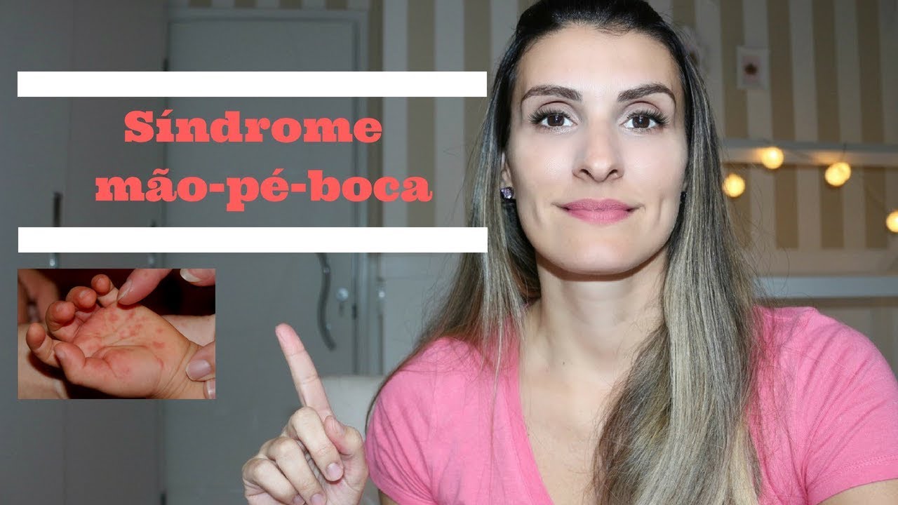 Bebê com síndrome  Mão Pé Boca, fotos, Sintomas, reações, febre , quanto tempo dura, o que fazer .