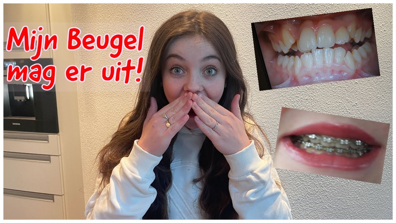MIJN BEUGEL MAG ER EINDELIJK UIT!!! - Bibi