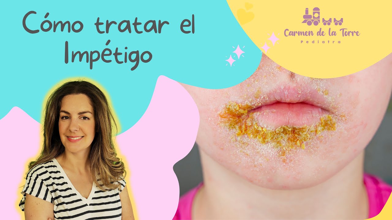 IMPÉTIGO, UNA INFECCIÓN MUY FRECUENTE