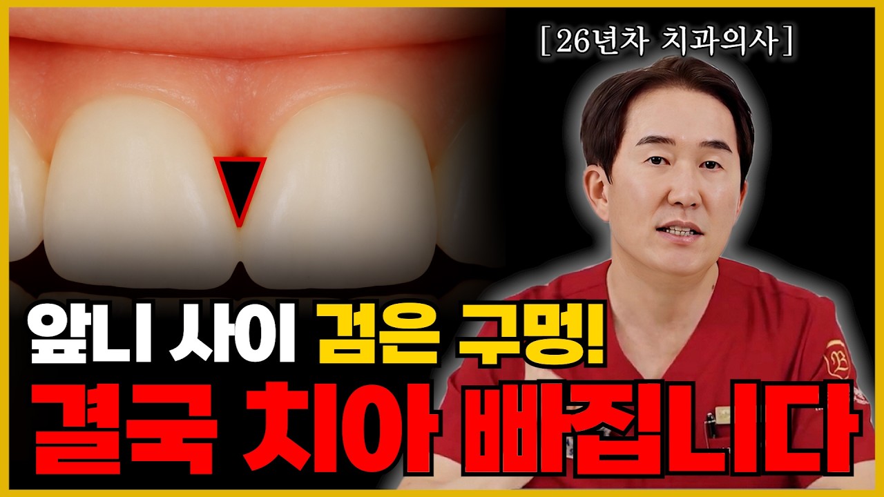 앞니 사이 검은 구멍, 임플란트 하기 싫으면 꼭 보세요 (26년차 치과의사) [천안]