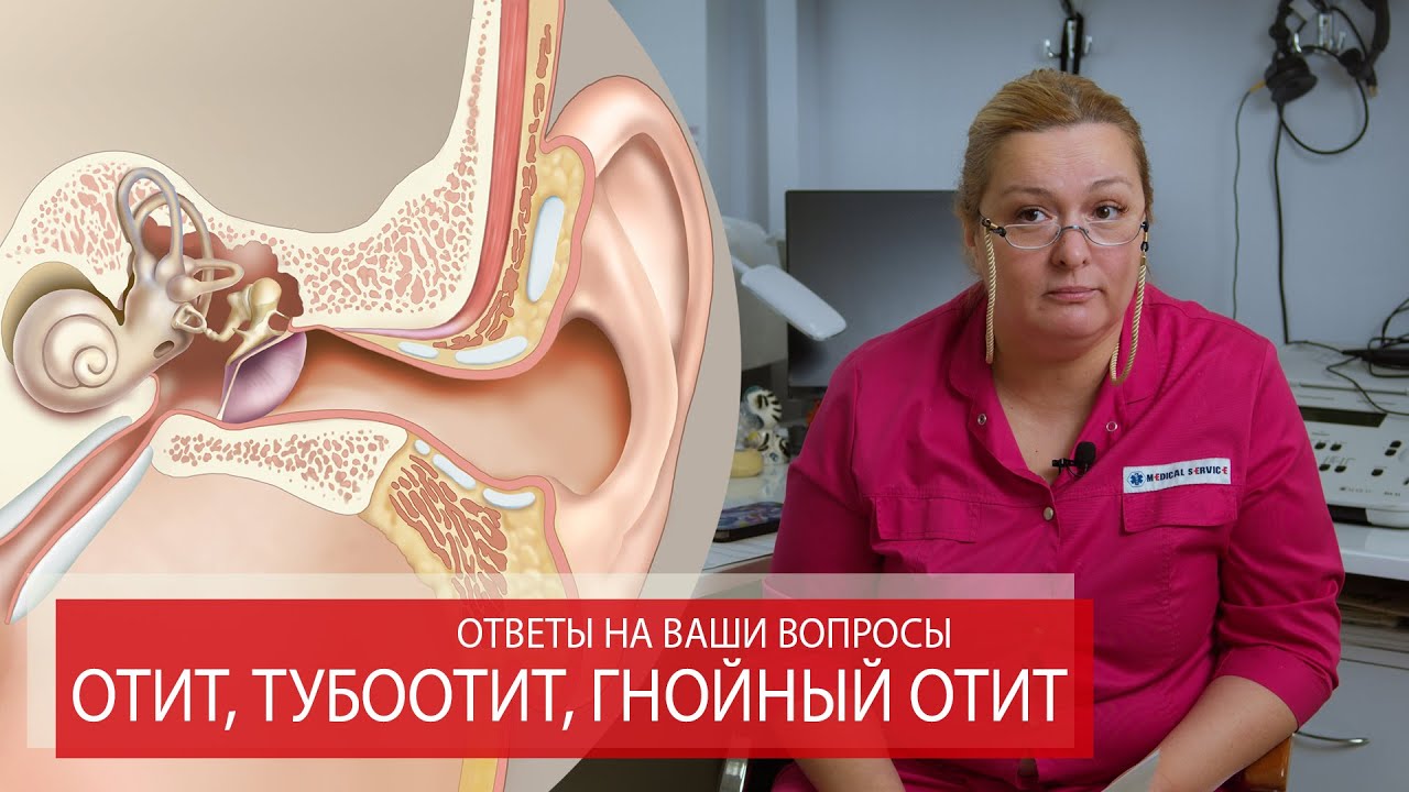ОТИТ, ТУБООТИТ, ГНОЙНЫЙ СРЕДНИЙ ОТИТ | Ответы на ваши вопросы.