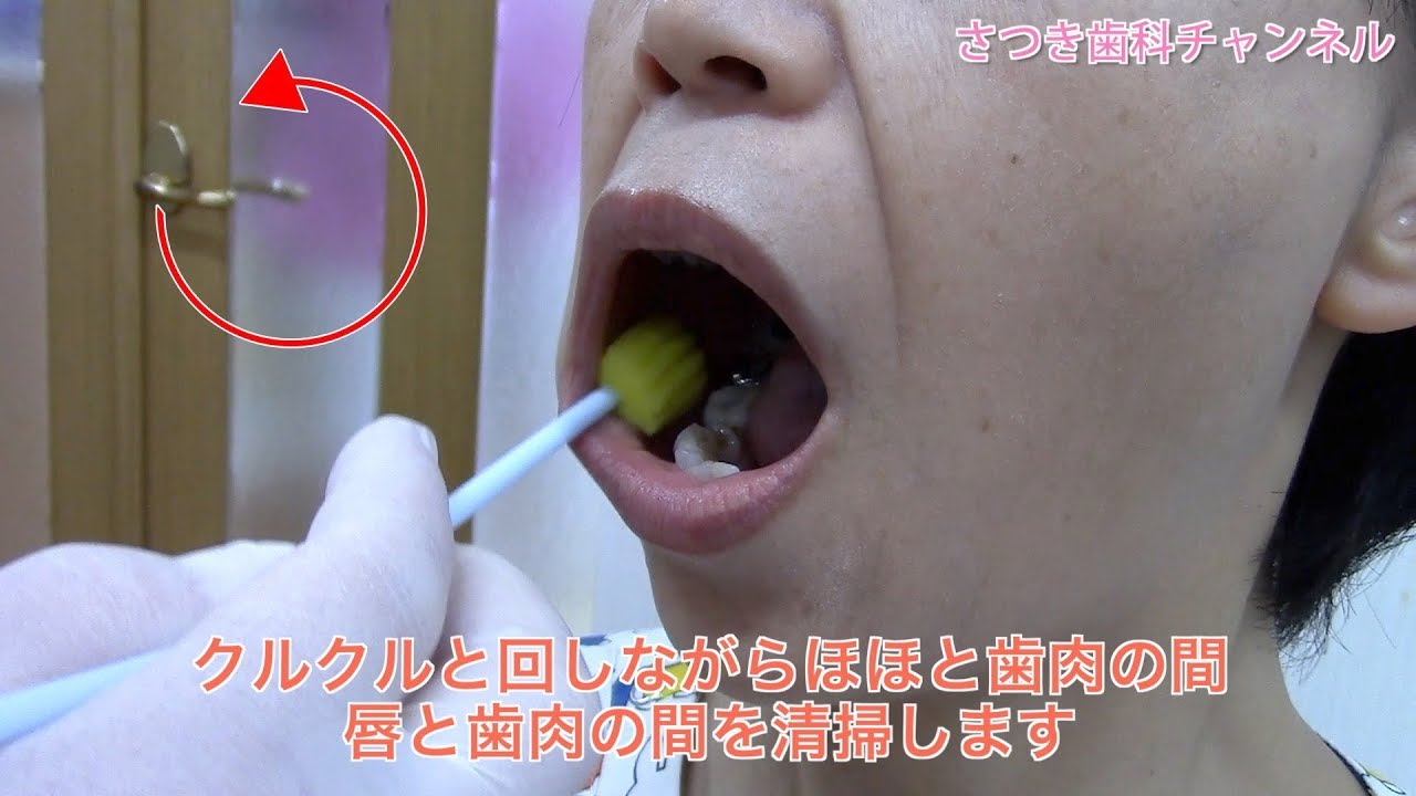 【青森_十和田市_歯医者】スポンジブラシで粘膜清掃_さつき歯科チャンネル001（口腔ケアチャンネル）