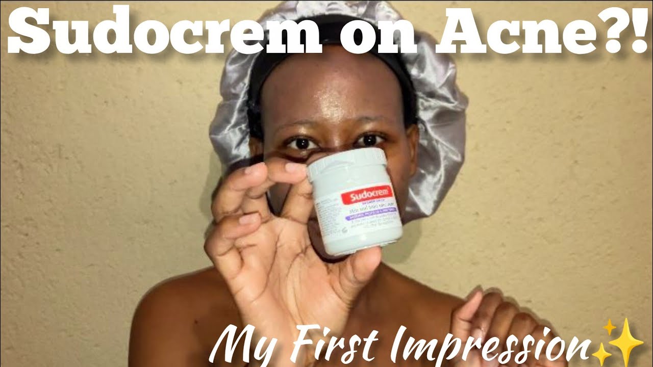 Trying Sudocrem for Acne & Skin Barrier Repair (First Impressions)