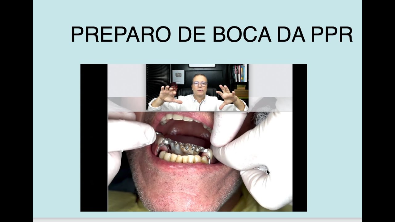Prótese Parcial removível: preparo de boca