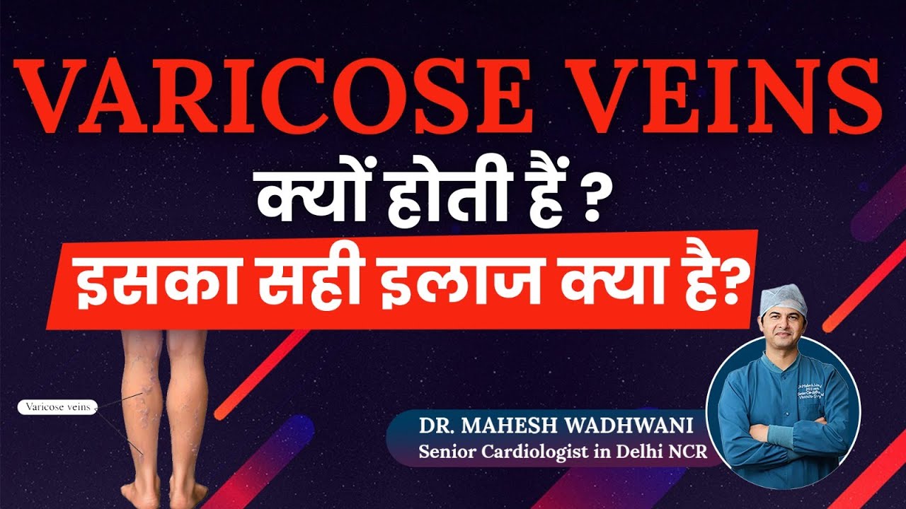 Varicose Veins का सही इलाज क्या है? l What are Varicose Veins l How to Treat Varicose Veins