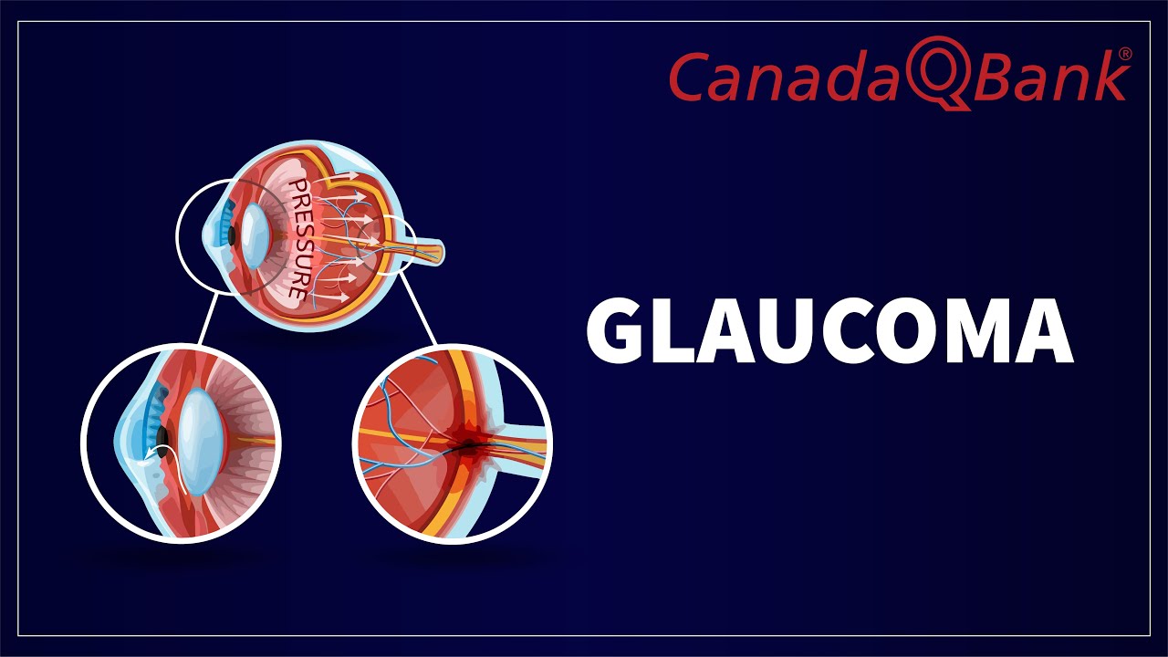 Glaucoma: Types, Symptoms, Diagnosis & Treatment | High-Yield Ophthalmology | CanadaQBank