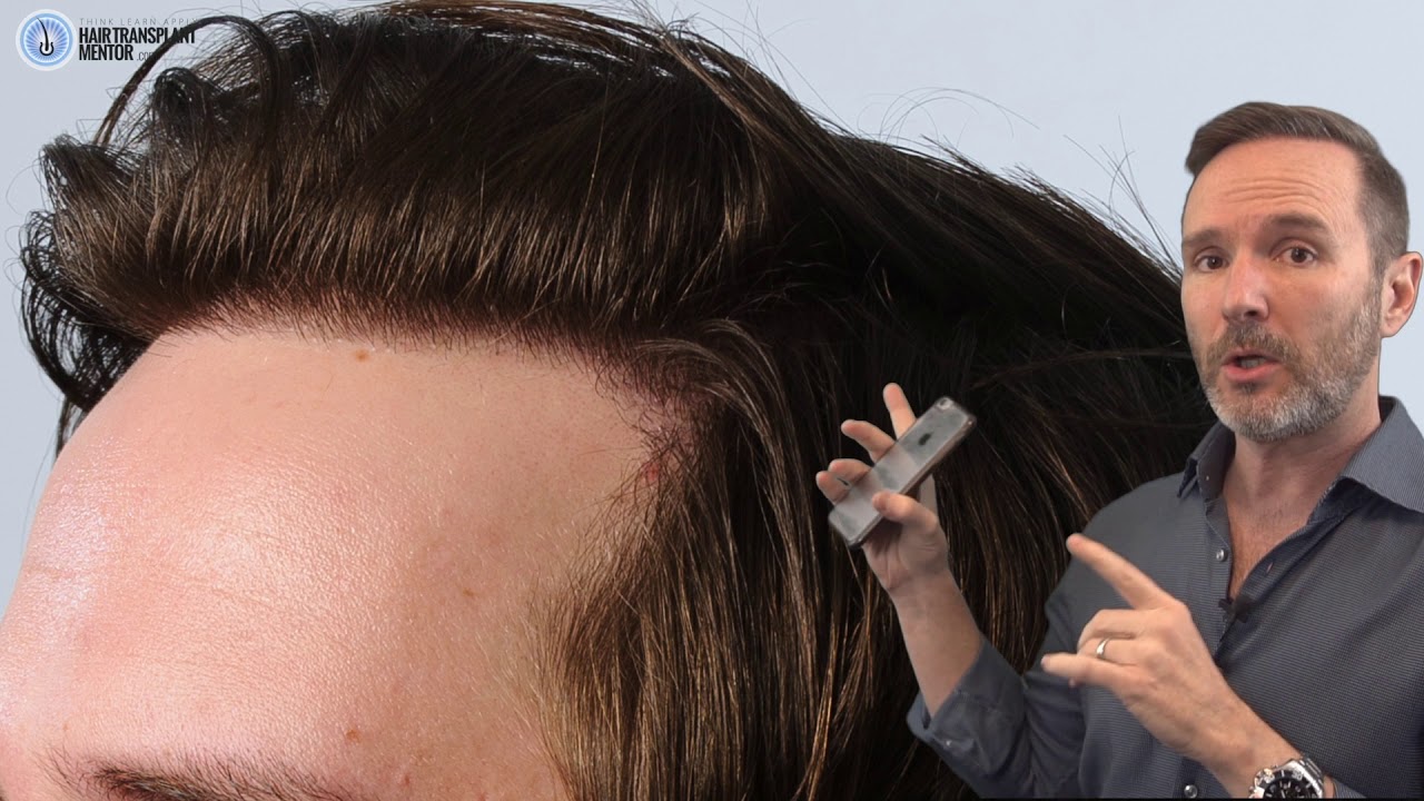 Los Angeles Hair Transplant FUE specialist Dr. Baubac of Alvi Armani in Beverly Hills