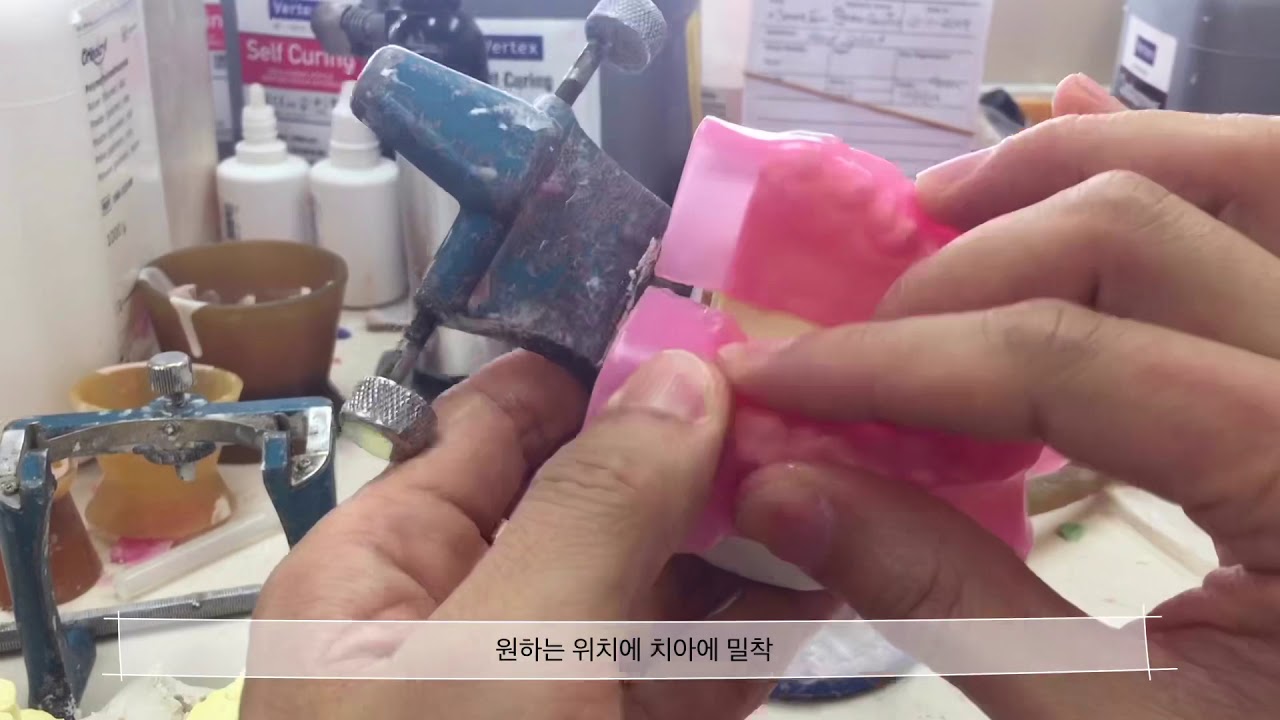 치아 스플린트 제작 과정 Processing of Splint